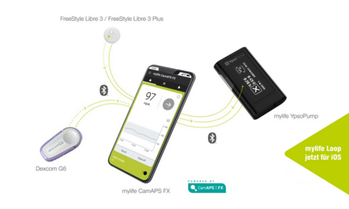 mylife Loop: Das AID-System von Ypsomed für Patienten